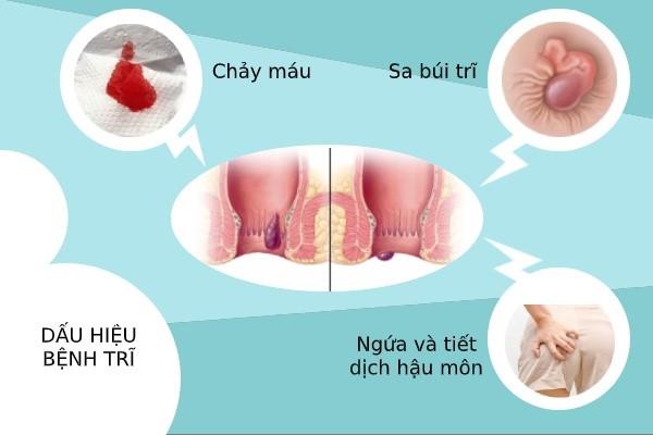 Bệnh trĩ là gì có nguy hiểm không? 