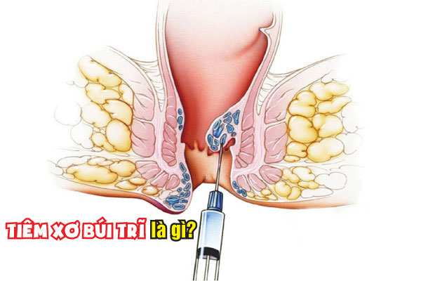 Cắt trĩ nội soi ống cứng bằng phương pháp tiêm xơ búi trĩ