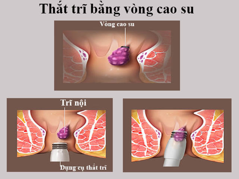 Phương pháp cắt trĩ nội soi: Thắt trĩ bằng vòng cao su