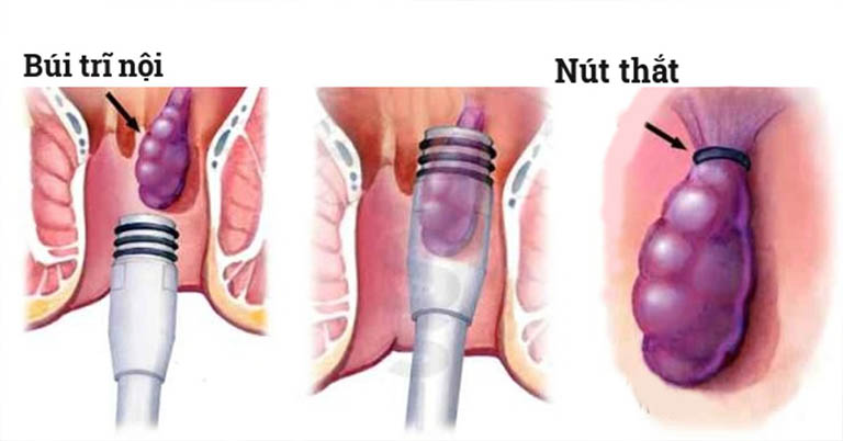 Mổ trĩ nội soi ống cứng – Thắt trĩ bằng vòng cao su