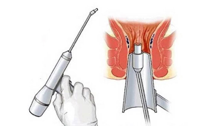 Phẫu thuật cắt trĩ bằng laser 
