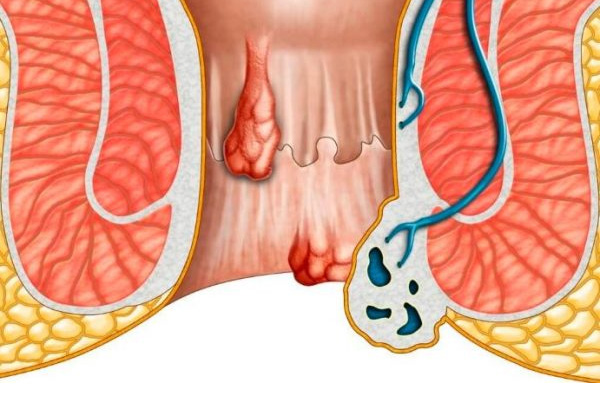 Trĩ ngoại và trĩ ngoại tắc mạch là gì?