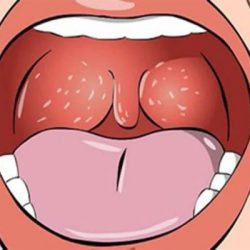 https://tribenhtri.com.vn/wp-content/uploads/2023/10/benh-lau-o-mieng-250x250.jpg