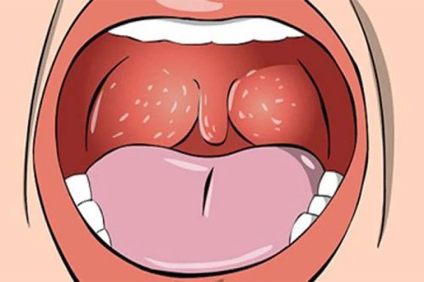 Bệnh lậu ở miệng là gì, đâu là nguyên nhân hình thành bệnh?